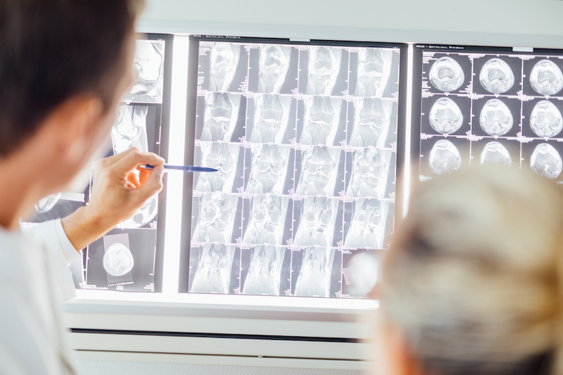 Auf den Röntgenbildern sieht man einen gesunden Knorpel mit ausreichendem Gelenkspalt zwischen Oberschenkelknochen (Femur) und Schienbein (Tibia)