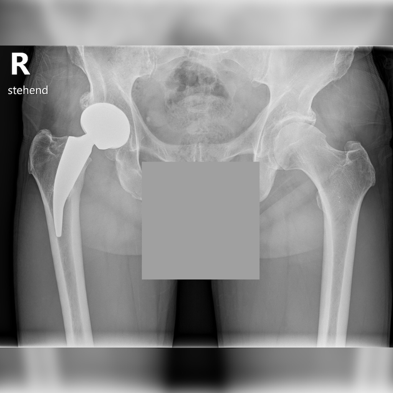 Röntgenaufnahme mit Kurzschaftprothese (rechts) zeigt, dass weniger Knochensubstanz bei Implantation verloren geht